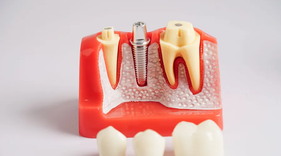 Dental Implants at CrossPointe Dental